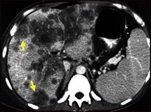 cancer-hepatico