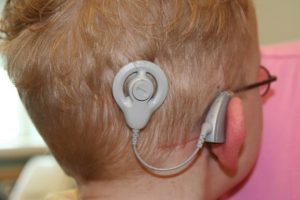 implantes-cocleares