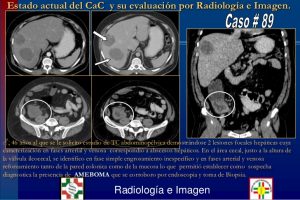 cancer-colon