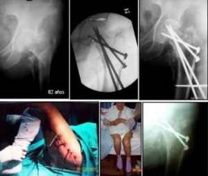 fractura-cadera
