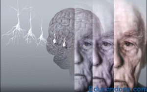 alzheimer