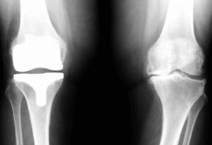 artrosis-rodilla