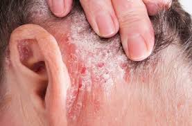 psoriasis