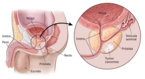 cancer-de-prostata
