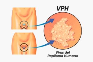 vhp
